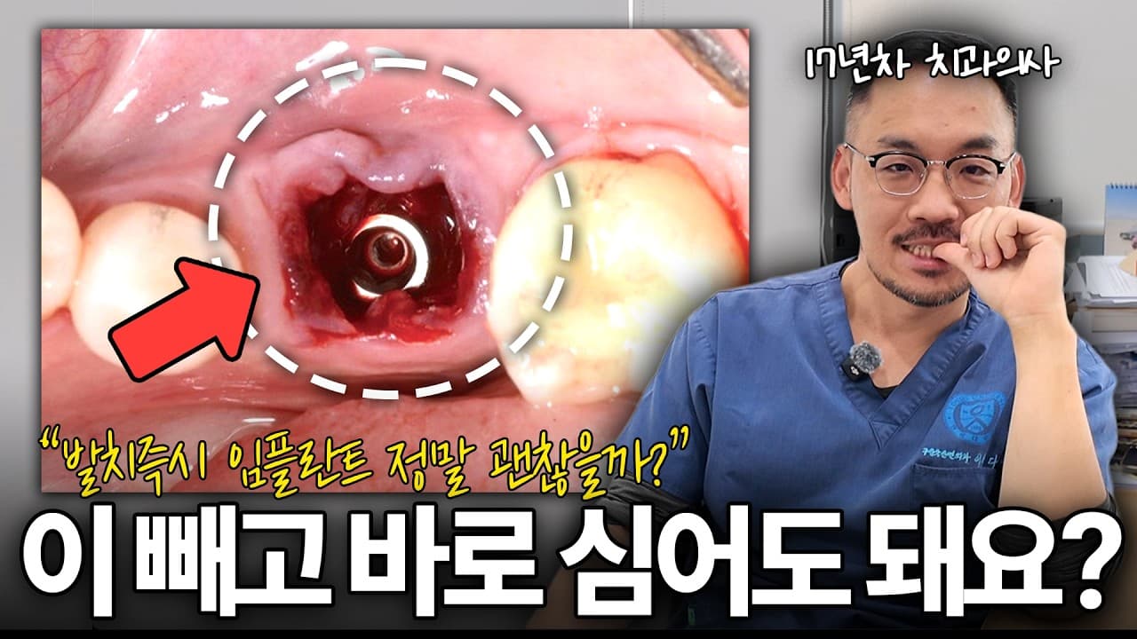 발치 즉시 임플란트, 염증 심할 땐 오히려 독 된다
